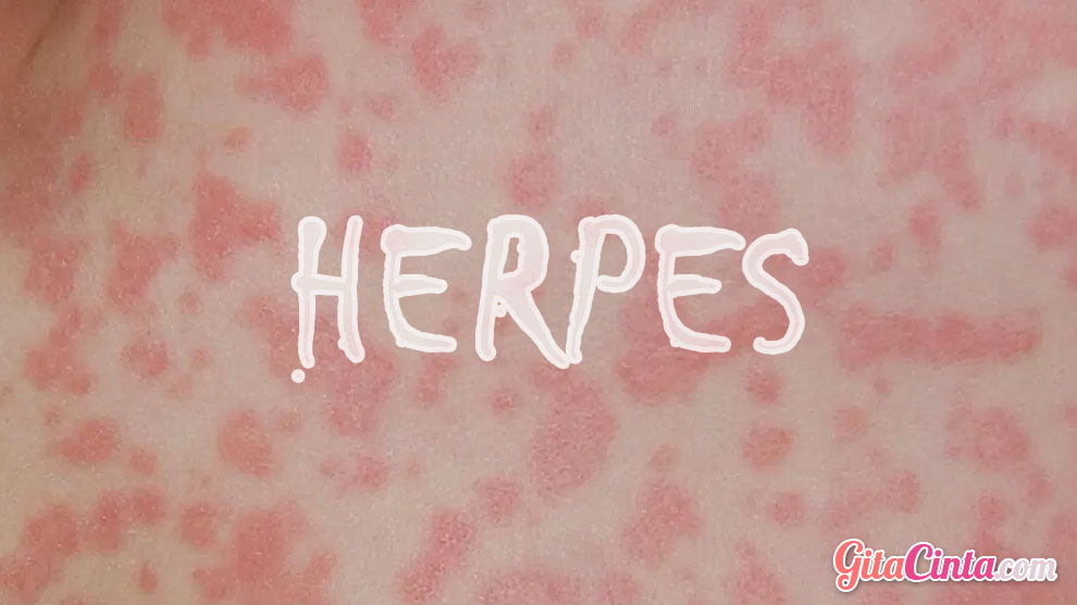 Tanda Tanda Penyakit Herpes dan Pengobatannya GitaCinta com